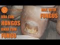 Toenail with fungus [Podología Integral] Integral Podiatry