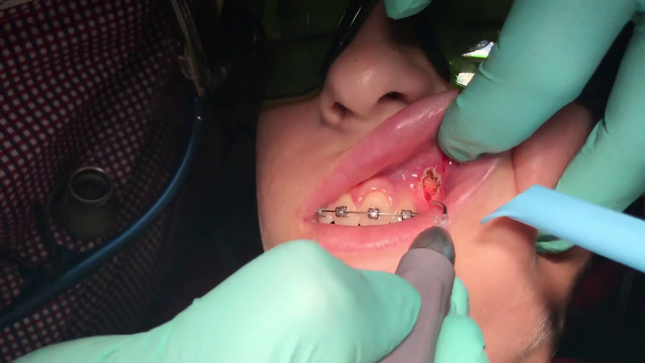 Laser Exposure for Orthodontic Treatment YouTube