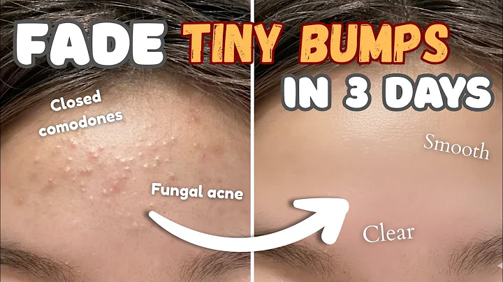 How to get rid of TINY BUMPs on face 🎀 at home NATURALLY || Closed comodones & Fungal acne