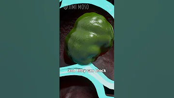 Coca Cola Vs Bezoars Wild Medical Use Of Soda Shorts Science Chemistry Medical Weirdfacts 