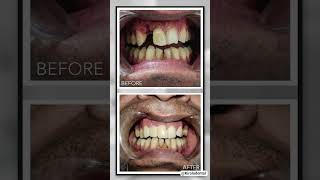 before after smile transformation: #shorts #dentistry #dental viral #youtubeshorts