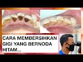 Pembersihan Gigi Yang Menghitam | Scaling | Dokter Gigi Griya RR