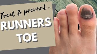 Runners Toe: How to prevent and treat black toenails