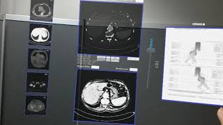 An Augmented Reality Application for Endovascular Aortic Repair Procedures screenshot 1