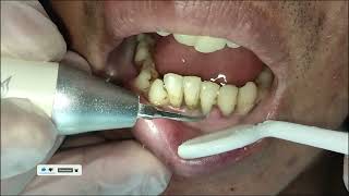 Top Teeth Cleaning Videos, Top Dentist ASMR, Dental treatment, Bracket Teeth, Tooth Braces by Dr Yayayue (牙牙月姐) 13 views 4 months ago 3 minutes, 6 seconds