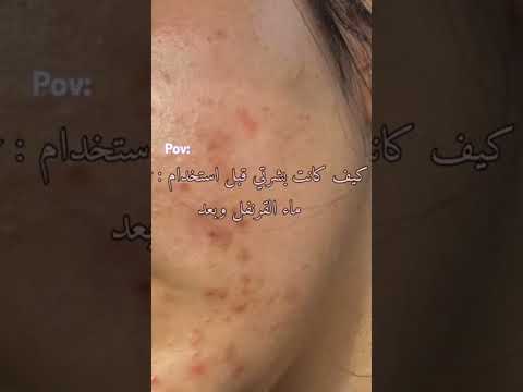 فوائد ماء القرنفل للبشرة و الحصول على البشرة الصافيه  