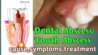 Dental Abscess: Cause, Symptoms, Treatment & Prevention | Periapical abscess | Periodontal abscess