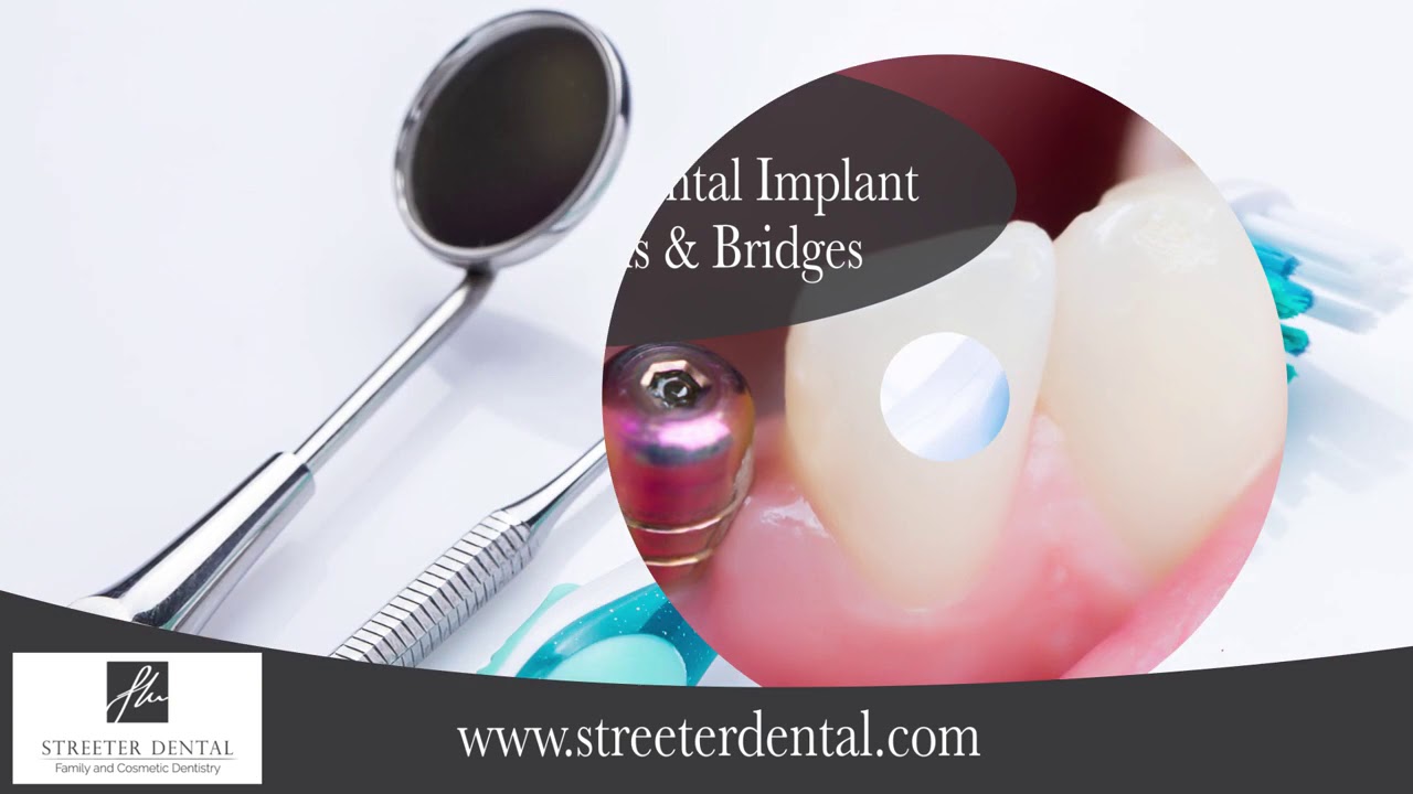 Implant Dentistry in Colorado Springs CO, details at