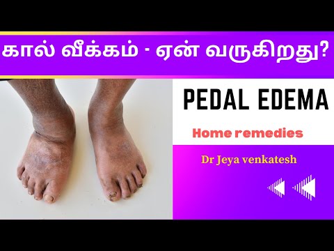 கால் வீக்கம் குறைய என்ன வழி ? Leg swelling causes & treatment Tamil - Dr JV