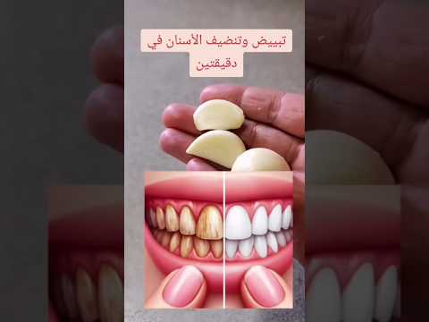وصفة طبيعية لتبييض الاسنان تبييض الاسنان
