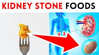 17 Foods That Turn into KIDNEY STONES