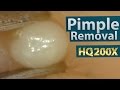 Pimple(acne) Removal Close up 200X - Blackheads Removal | 200倍でニキビを潰す(芯を除去)