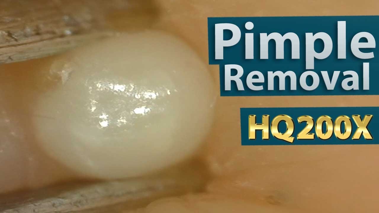 Pimple Acne Removal Close Up 0x Blackheads Removal 0倍でニキビを潰す 芯を除去 Youtube