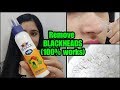 HOW TO REMOVE BLACKHEADS PERMANENTLY - EASY AND PAINLESS METHOD