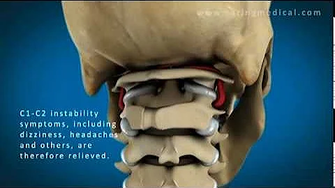 C1 and C2 Atlantoaxial Instability: Upper Cervical Instability and Prolotherapy animation