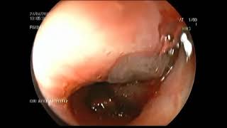 Managing Live Leech and Roundworm Endobronchial Infestation