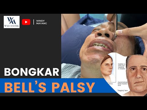 BONGKAR KASUS BELL’S PALSY