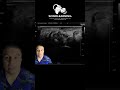 Ruptura parcial del nervio mediano #msk #ultrasound #enseñanza #cursoonline #ecografia #sonography