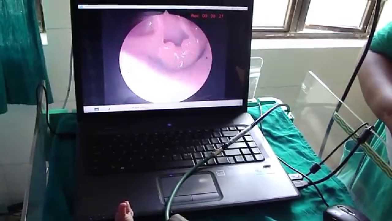 RIGID ENDOSCOPIC EXAMINATION OF NEONATAL LARYNX 03 YouTube