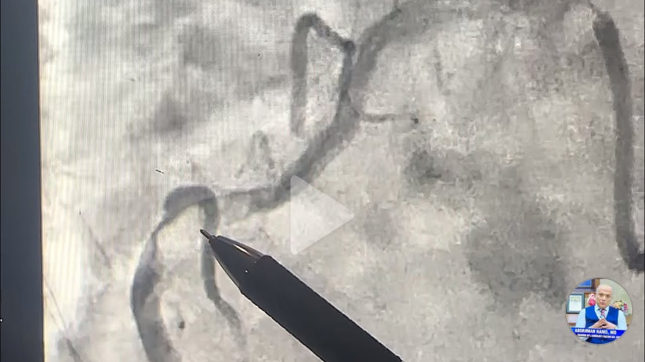 Complex PCI tips and trips: Crushing a Rock-Hard RCA, Step-by-Step Guide! 