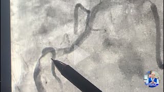 Complex Pci Tips And Trips Crushing A Rock-Hard Rca, Step-By-Step Guide