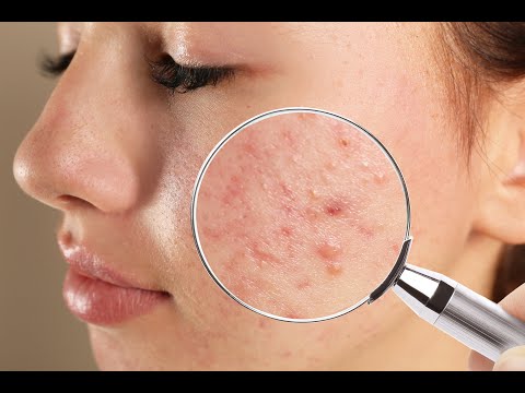 Antibiotic breakthrough for acne sufferers