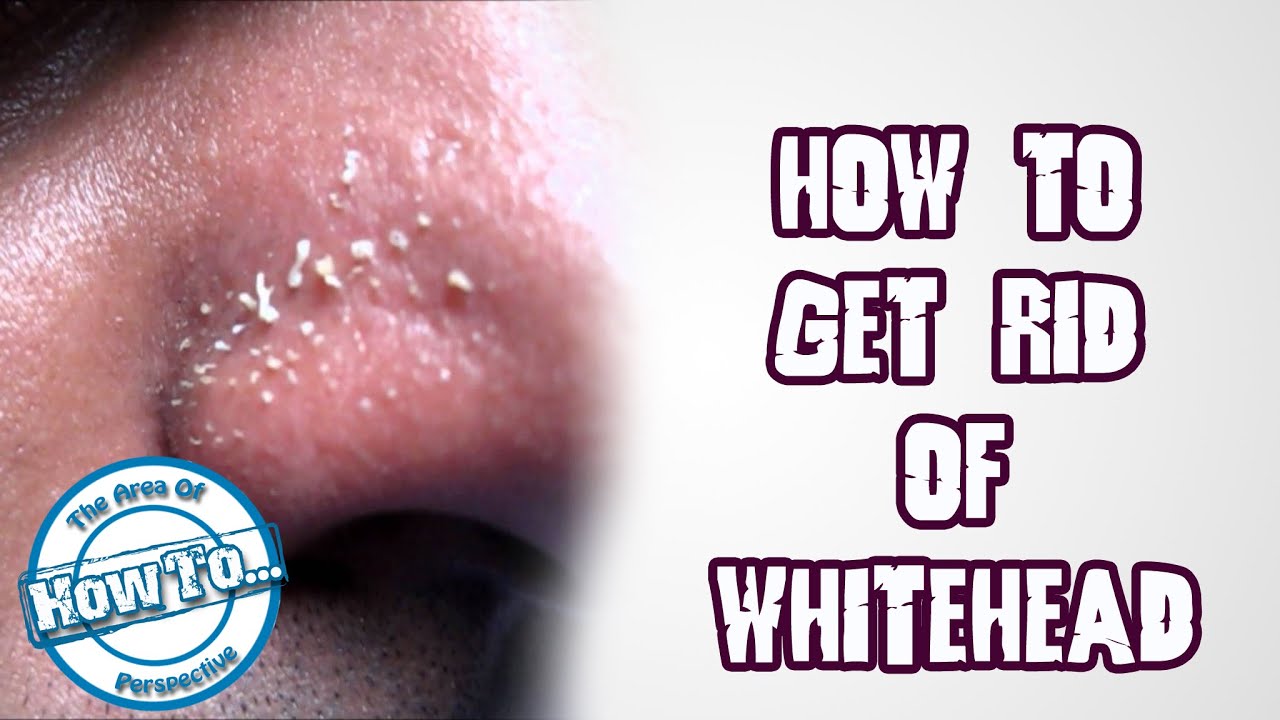 How to get rid of whistling dick