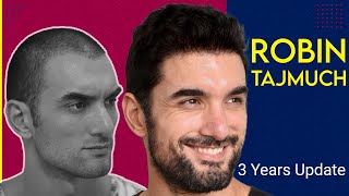 Super-amazing results of Supermodel Robin  | 3 years update | Hair Transplant @EugenixHairSciencesofficial
