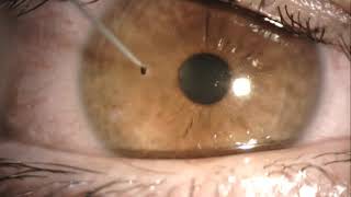 corneal foreign body removal like a boss