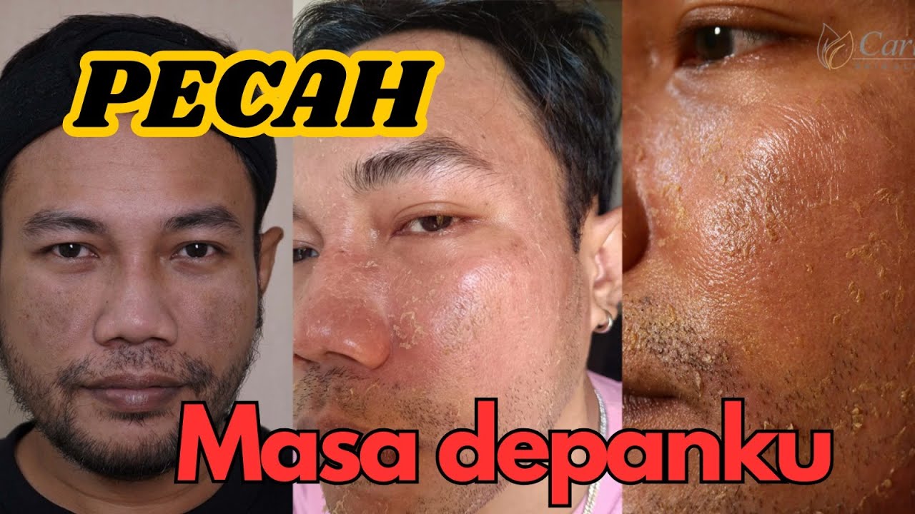 Amazing Result Treatment Hyperpigmentation