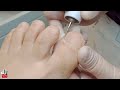 Nail Restoration 🦶 Nail cleaning for comfort and well-being