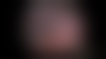 Laparoscopic Appendectomy - JustRight 5mm Stapler Highlight Clip