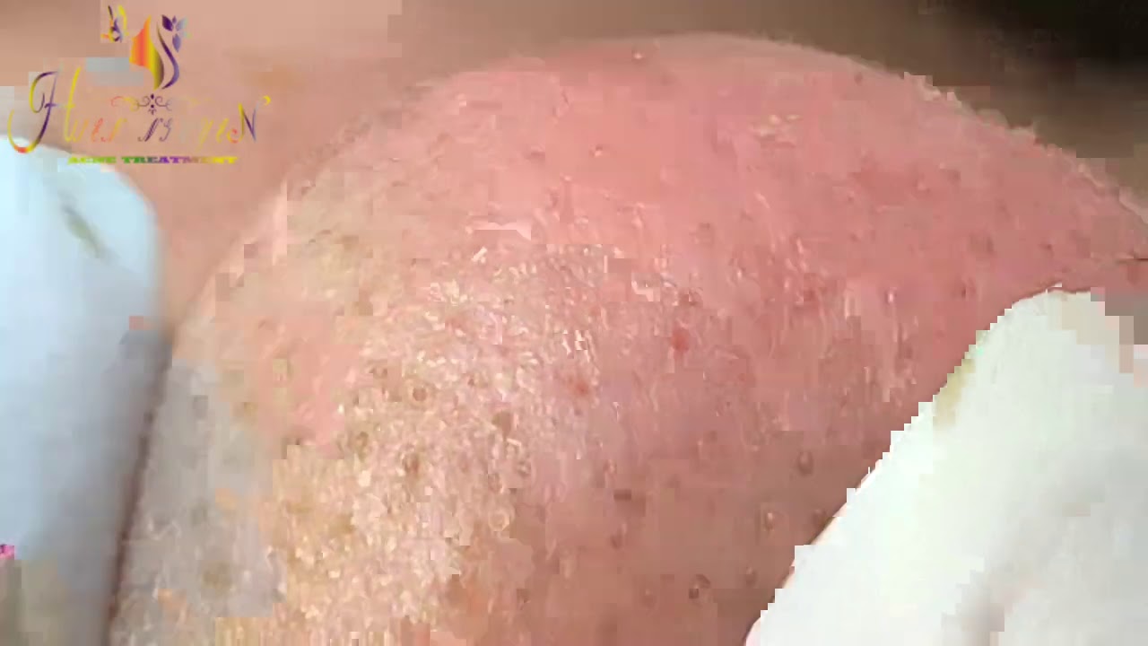 SPA HIEN NGUYEN ACNE TREATMENT | Blackhead extraction... - youtube
