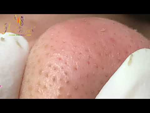 Video SPA HIEN NGUYEN ACNE TREATMENT | Blackhead extraction... - youtube