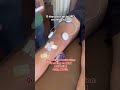 Quadriceps Activation:Focusing on quad activation Quadriceps Activation activation using NMES#acl