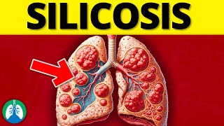 What is Silicosis? (EXPLAINED) 🫁