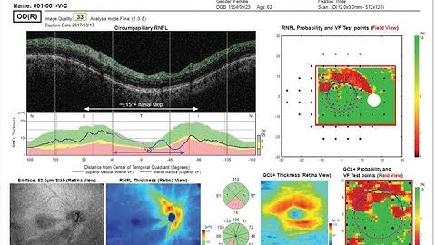 2021 OCT in Glaucoma (3)  Hood