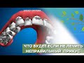 Что будет если не лечить неправильный прикус?