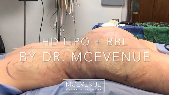 BBL (Brazilian Butt Lift) and High Definition Liposuction FULL SURGERY with  before and after! 