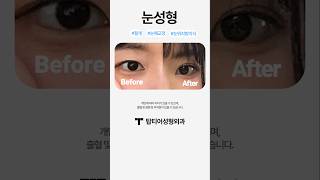 자연스러운 눈성형 잘 하는 곳을 찾는다면?