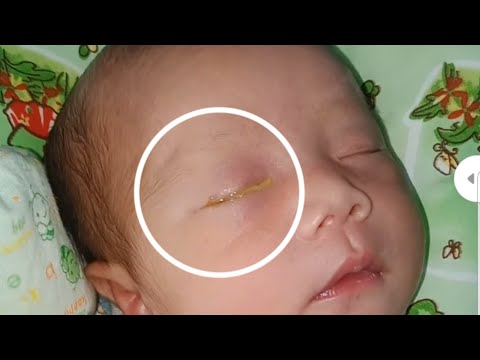 Video: Apakah bayi lahir dengan mata terbuka?