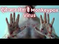 How Monkeypox virus KILLS? (3D Animation) #shorts