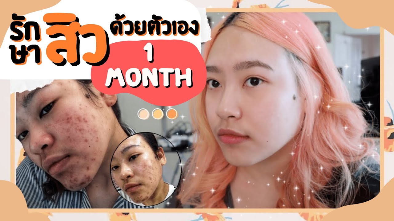 ครีมหน้า  New Update  รักษาสิวด้วยตัวเองใน 1 เดือน แบบไม่เจ็บตัว !! ทำยังไง ใช้อะไร บอกหมดไม่กั๊ก l nownow p.