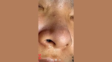 Skincare | Blackheads Removal #620 #tweezers skincare #blackheads blackheads