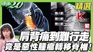 輕忽 頸椎神經壓迫 恐致手腳發麻、癱瘓肩背痛到難行走 竟是惡性腫瘤轉移脊椎釋放頸椎壓力這樣動【健康2.0精選】