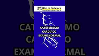 CATETERISMO CARDÍACO - EXAME NORMAL #hemodinâmica #hemodinamica #cardiologiaintervencionista #rx