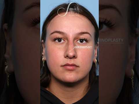 Video thumbnail: Liquid Rhinoplasty in Columbus, Ohio #nonsurgicalnosejob #nose #facialplasticsurgeon — Smith Facial Plastics