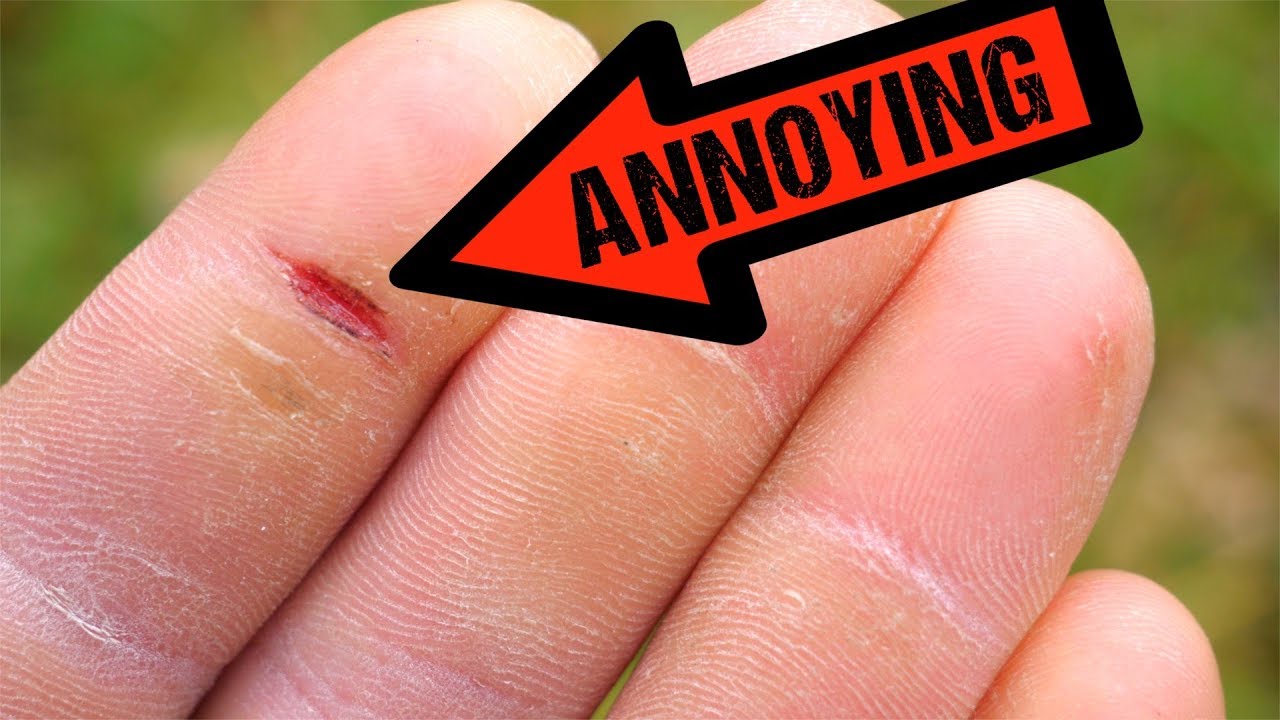 Climbing Skin Splits Treatment Prevention YouTube Climbing Skin Splits Treatment Prevention YouTube