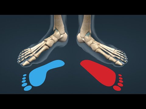 flat foot/ القدم المسطحة و أعراضها وعلاجاتها