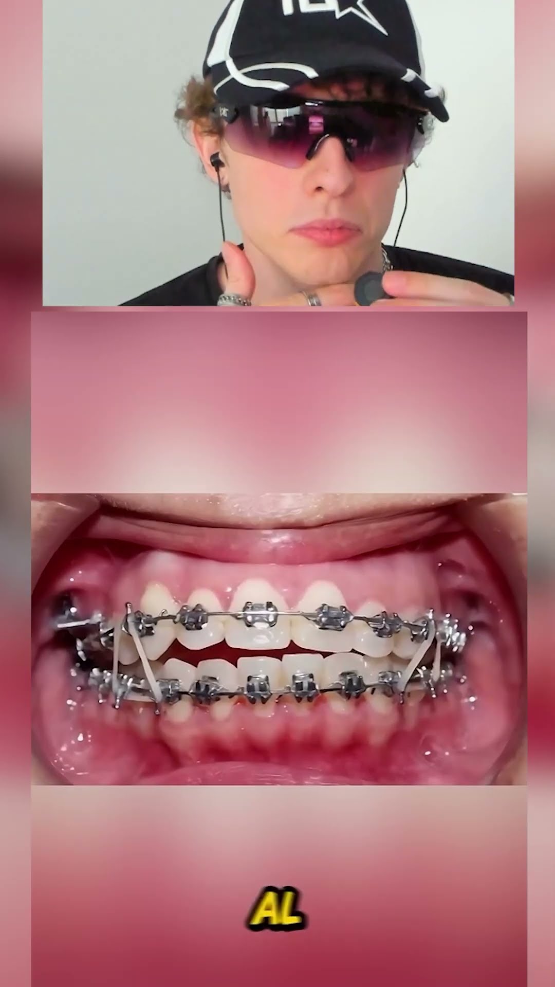 Como funcionan los BRACKETS?